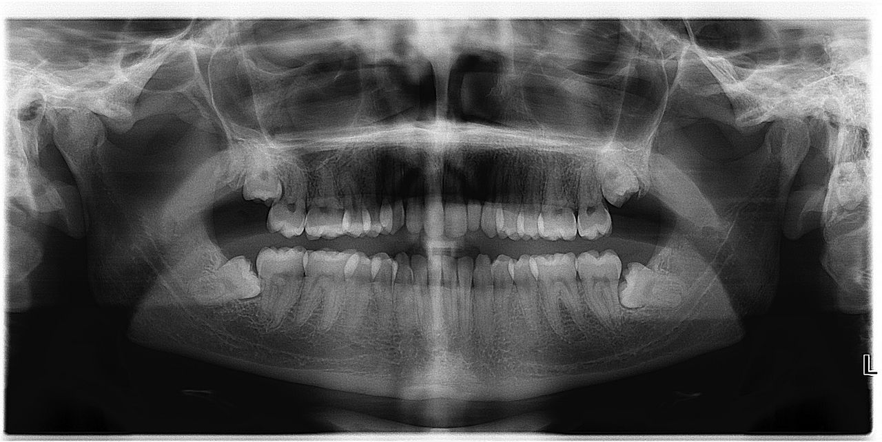 Possible Complications and Risks of Wisdom Teeth Removal
